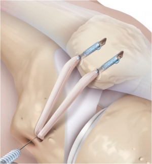 Anatomiczna dwupęczkowa rekonstrukcja troczków rzepki (MPFL) - technika operacyjna