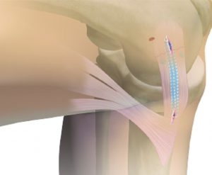 Augmentacja więzadła pobocznego piszczelowego MCL metodą Internal Brace™ opis + technika operacyjna
