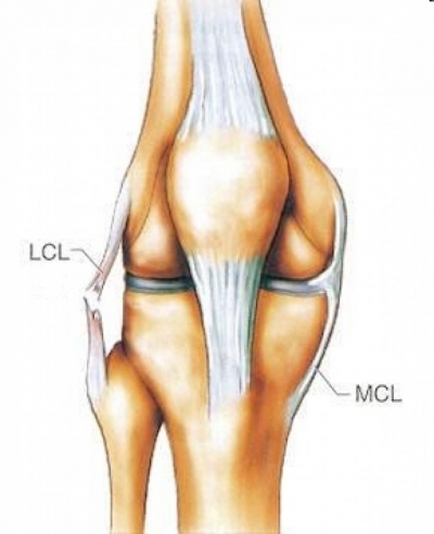 Uszkodzenie więzadła pobocznego piszczelowego MCL
